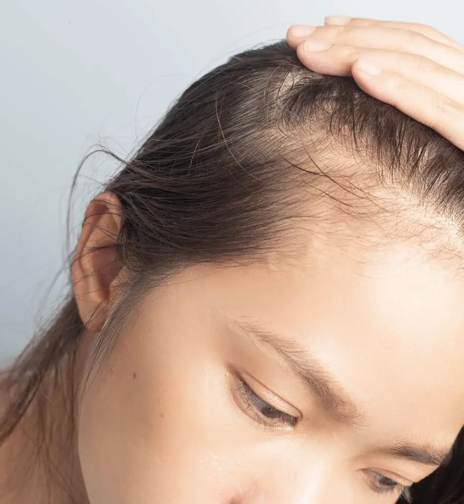 alopecia falsos mitos